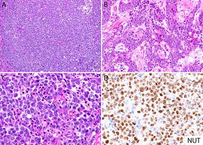 NUT Carcinoma: Clinicopathologic Features, Molecular Genetics and Epigenetics